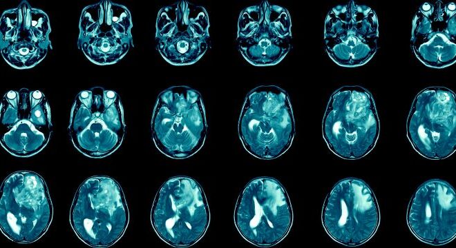 Key Insights into Glioblastoma and Its Management
